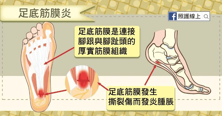 足底筋膜炎