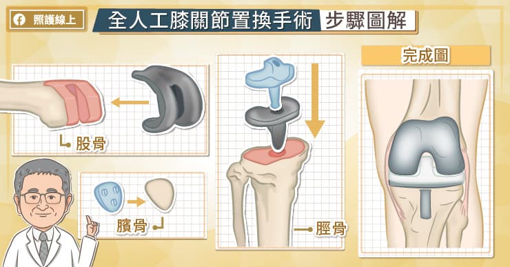 膝關節