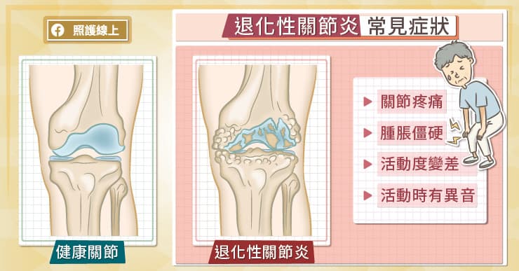 退化性關節炎