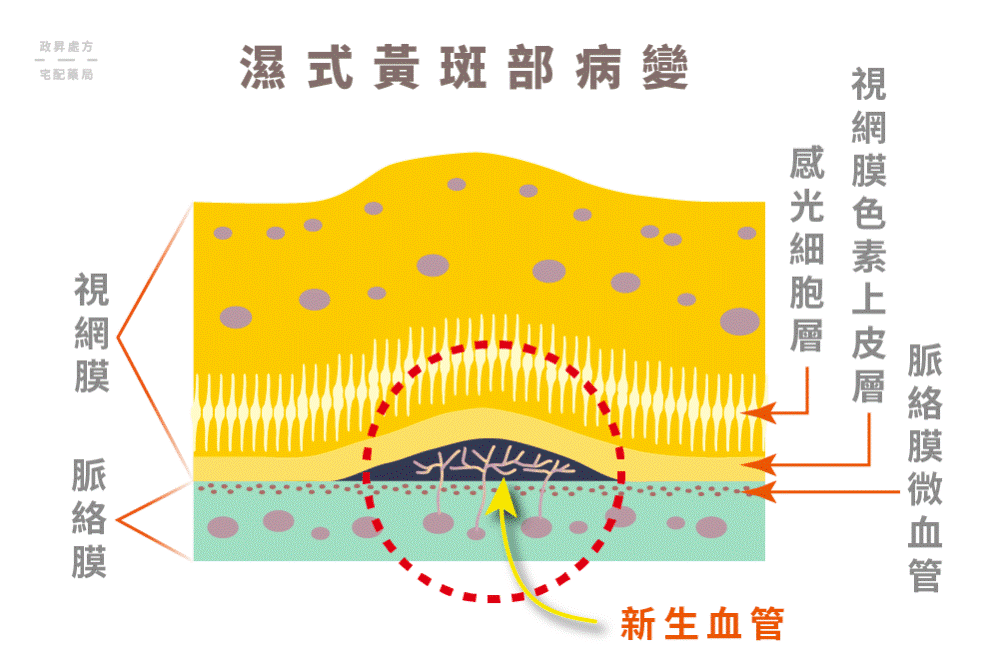 濕式黃斑部病變