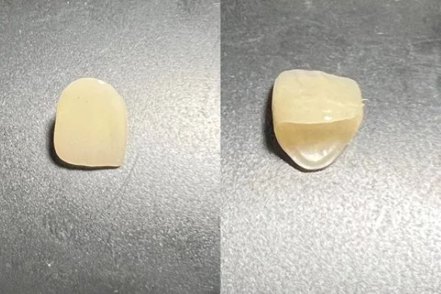 全瓷冠假牙色澤如真牙、穩定度高，較不易發生瓷崩現象。 圖／范綱信提供