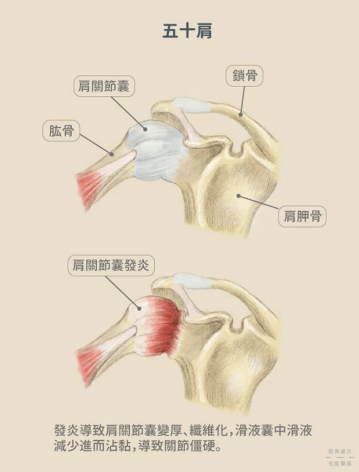 五十肩
