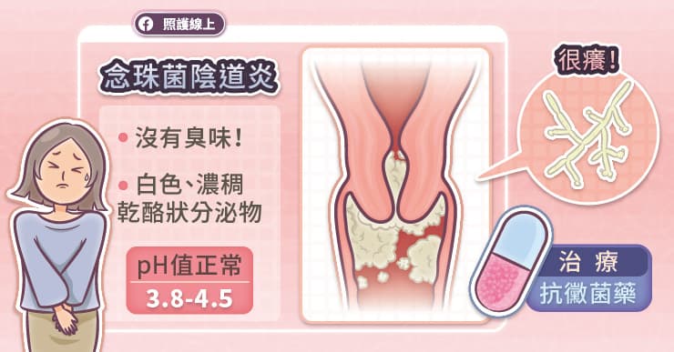 念珠菌陰道炎（Candida vaginitis）