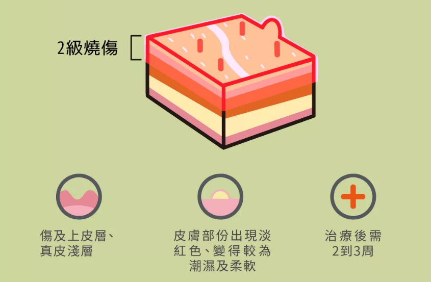 二度燒傷