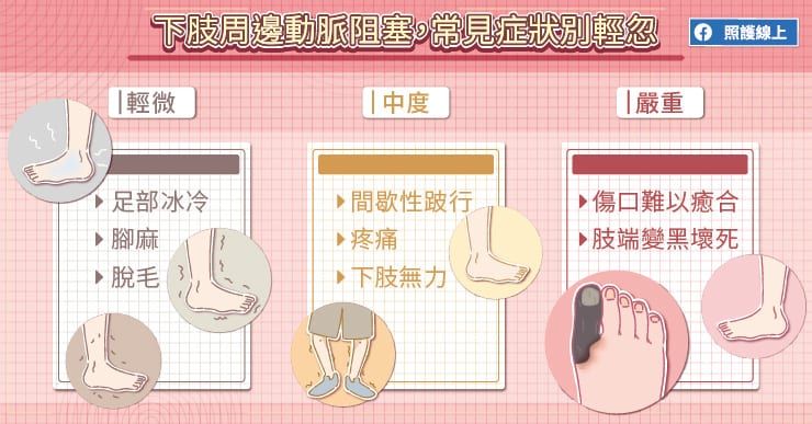 下肢周邊動脈阻塞,常見症狀別輕忽