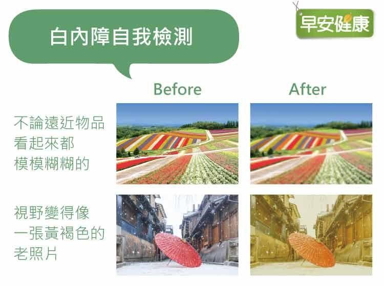 白內障