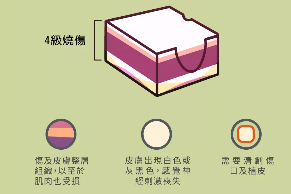 四度燒傷