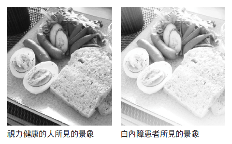 白內障