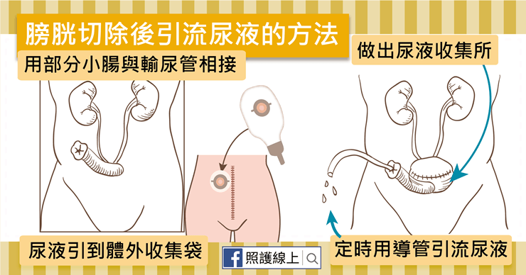 膀胱癌