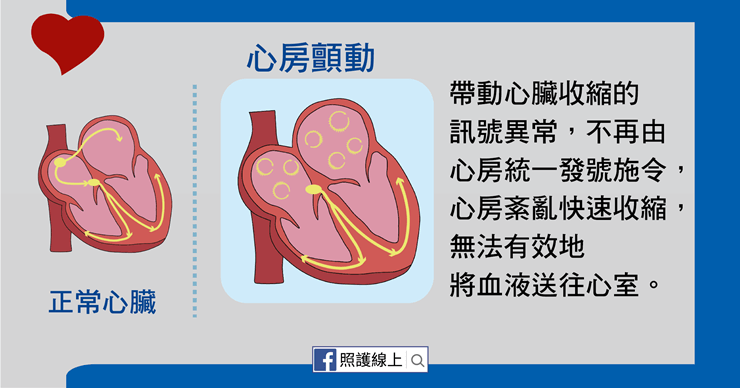 心房顫動