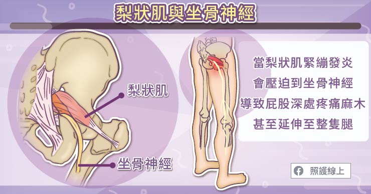 梨狀肌症候群