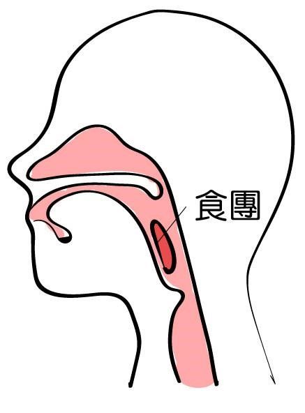 嗆咳