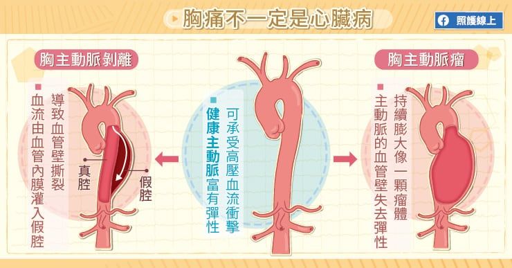 胸痛不一定是心臟病