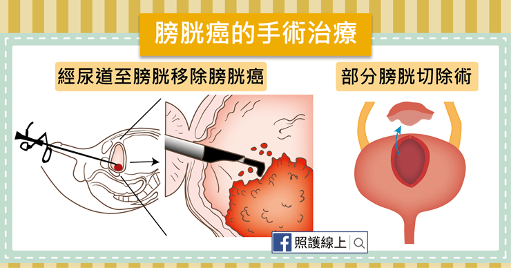 膀胱癌
