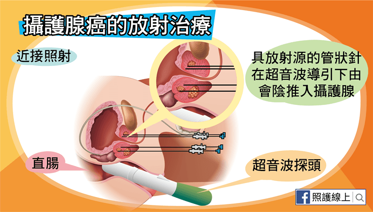 攝護腺