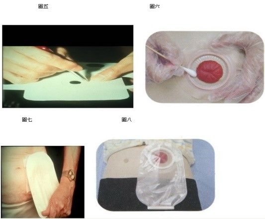 腸造口