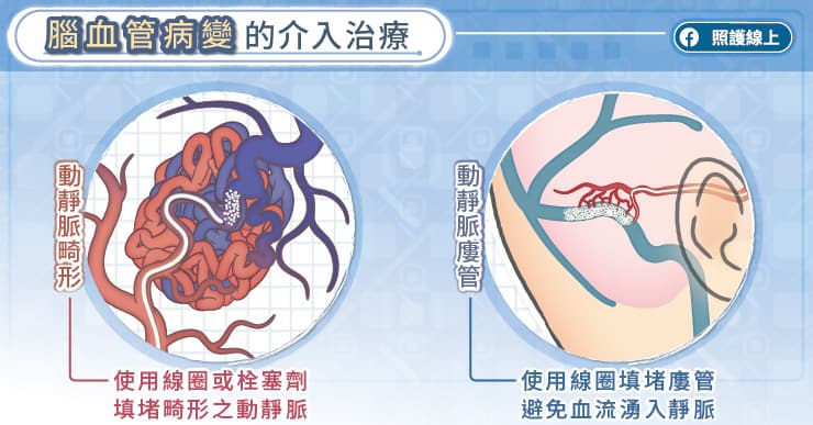 腦血管病變的介入治療