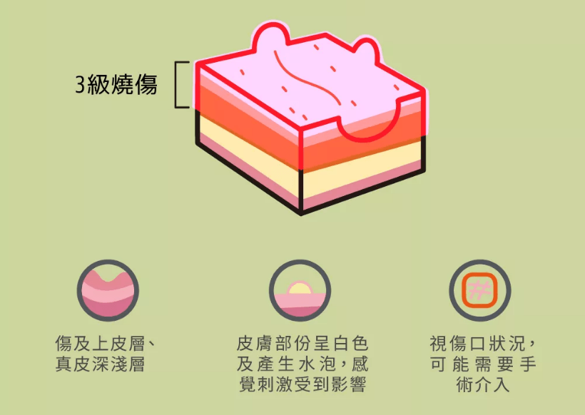 三度燒傷