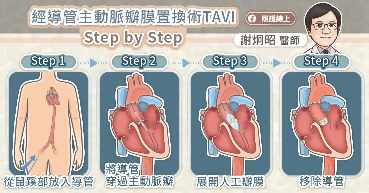 經導管主動脈瓣膜置換術TAVI
