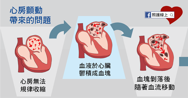 心房顫動