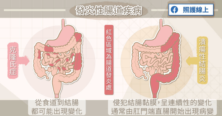 克隆氏症