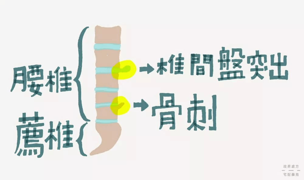 骨刺