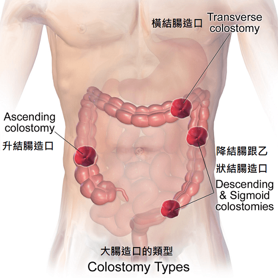 大腸造口