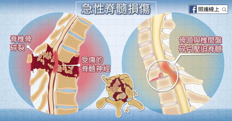 脊隨損傷
