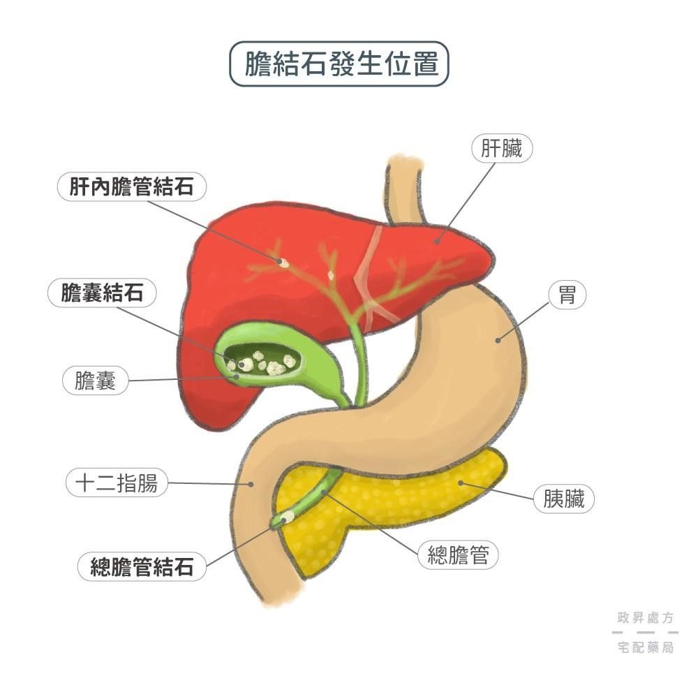 膽結石