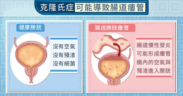 膀胱
