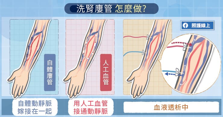洗腎