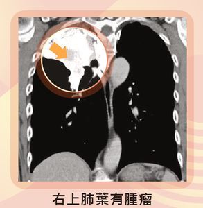 腫瘤