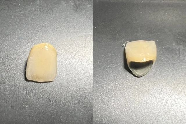 金屬燒瓷假牙費用比全瓷冠假牙便宜，但相對使用年限也較低。 圖／范綱信提供