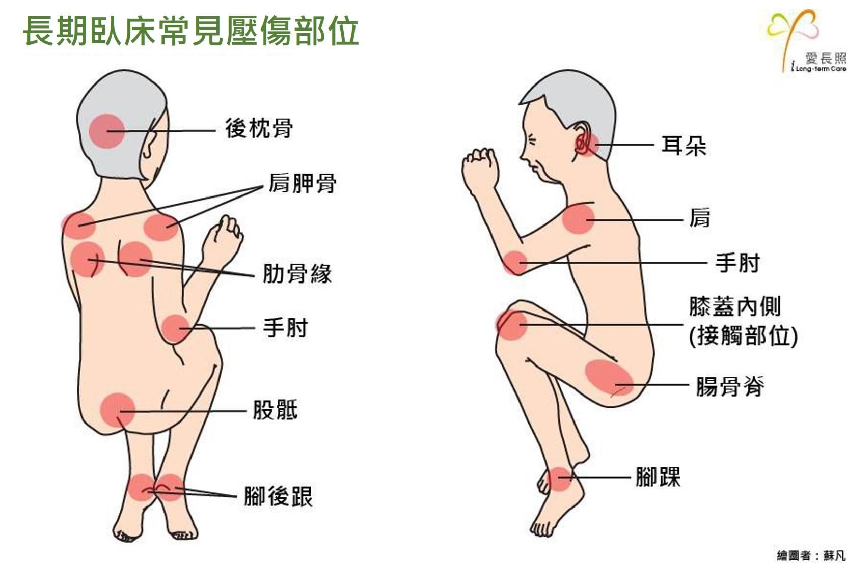 什麼是壓傷（舊名壓瘡）？為什麼壓傷可能造成病人死亡？